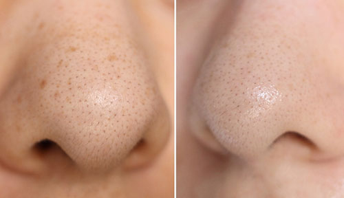Cách trị mụn đầu đen ở mũi tại nhà có thể bạn chưa biết