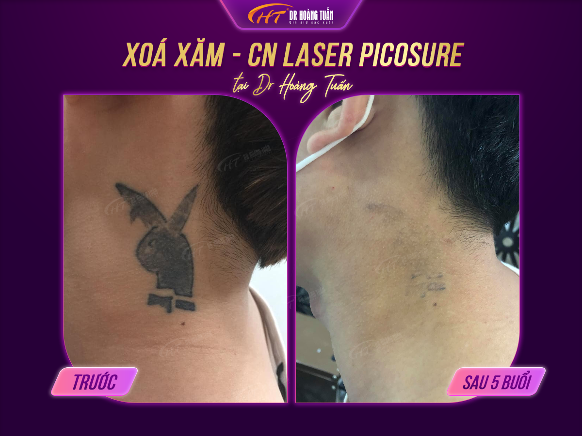 Minh họa quá trình xóa xăm bằng laser với các buổi điều trị khác nhau theo thời gian
