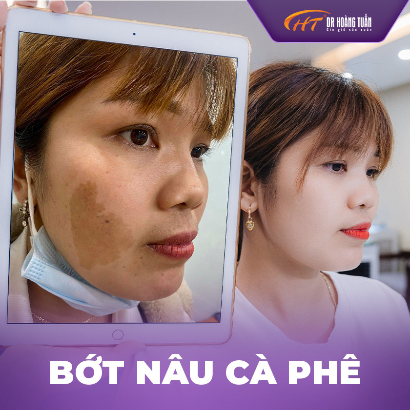 Bớt sắc tố nâu