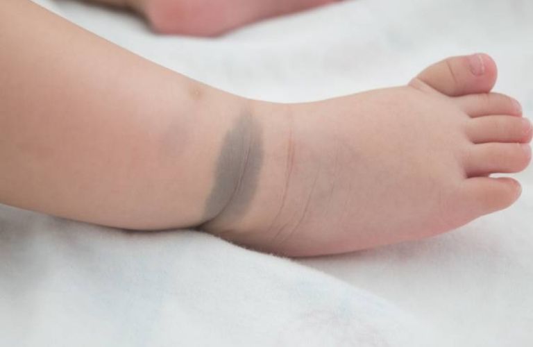 Giải mã các loại bớt sắc tố trẻ sơ sinh phổ biến hiện nay