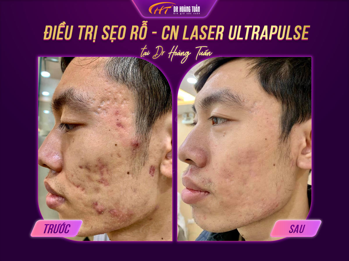 Nguyên nhân và cách điều trị sẹo rỗ sau mụn