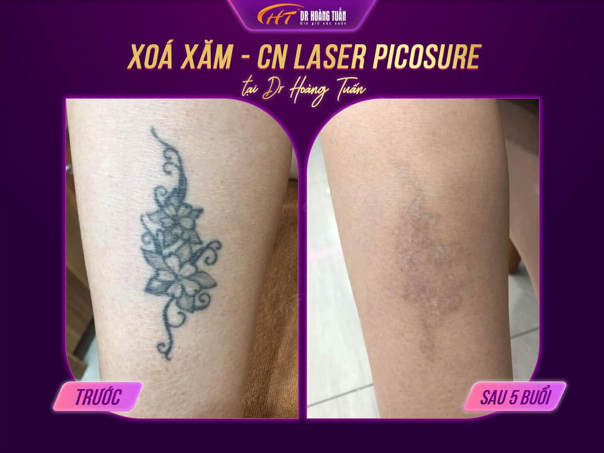 Quy trình xóa xăm laser hiện đại không để lại sẹo trên da tại cơ sở thẩm mỹ