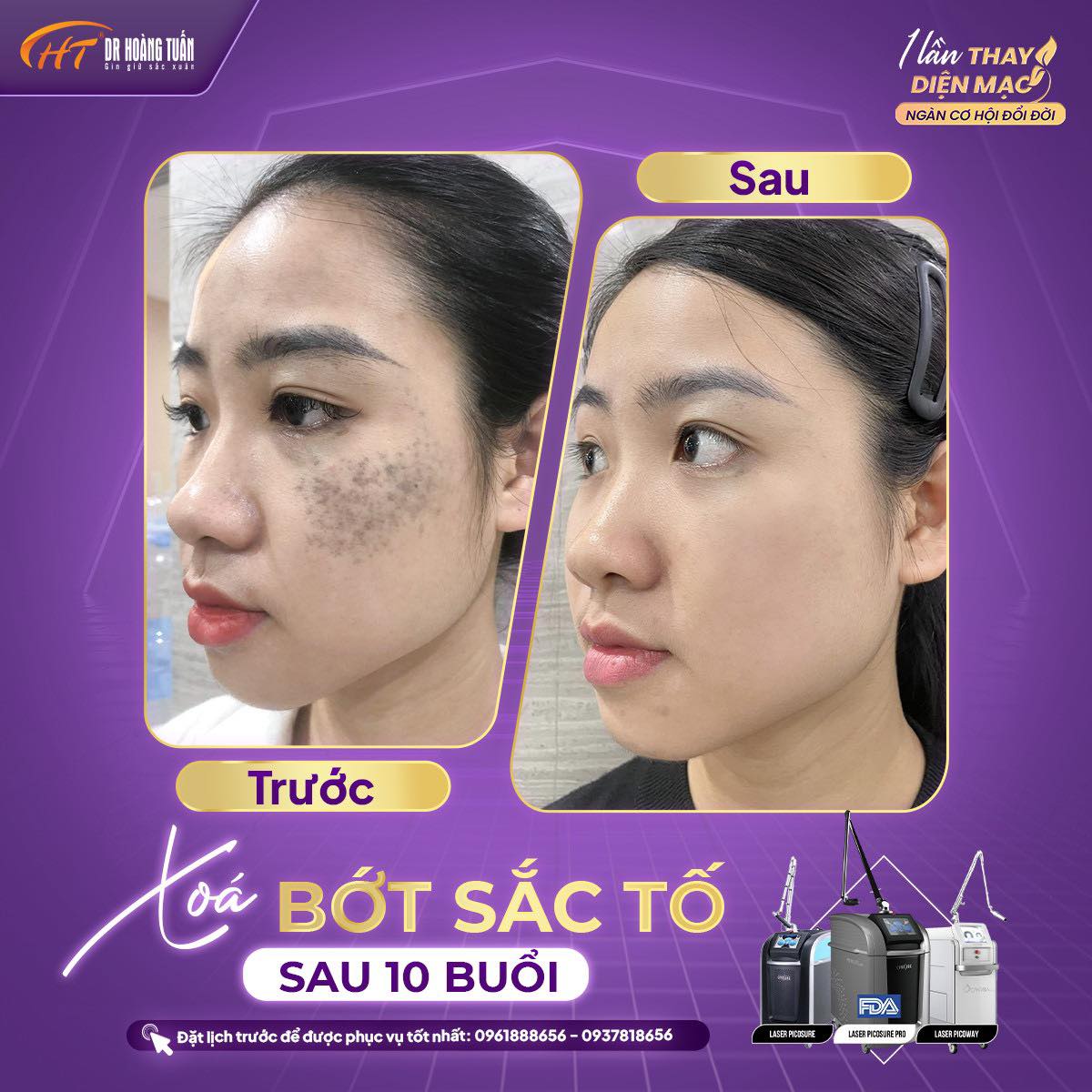 Bớt Sắc Tố Bẩm Sinh