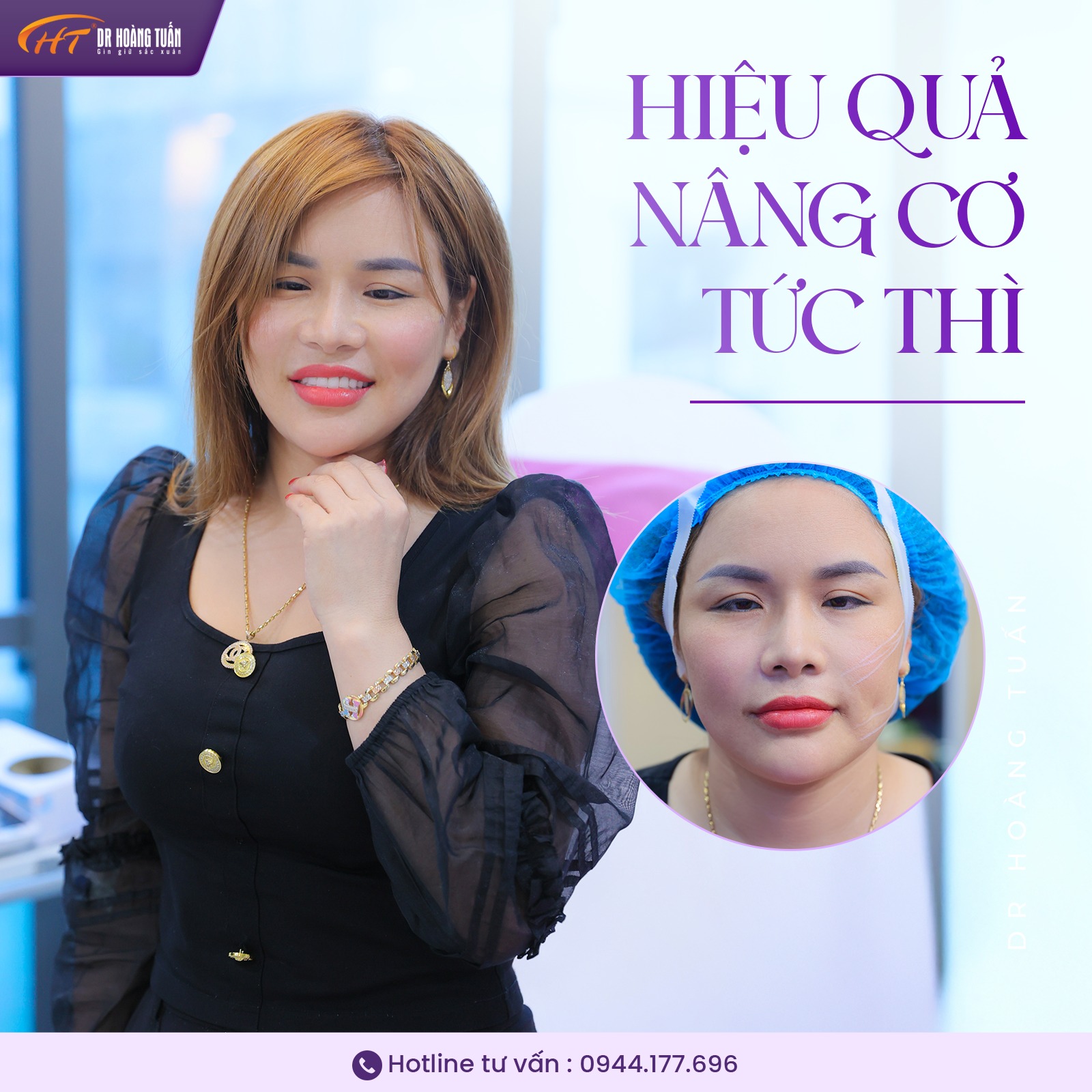 Căng chỉ da mặt được bao lâu