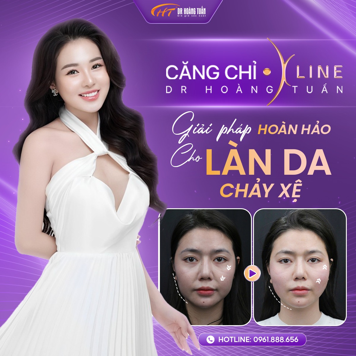 Căng chỉ da mặt được bao lâu