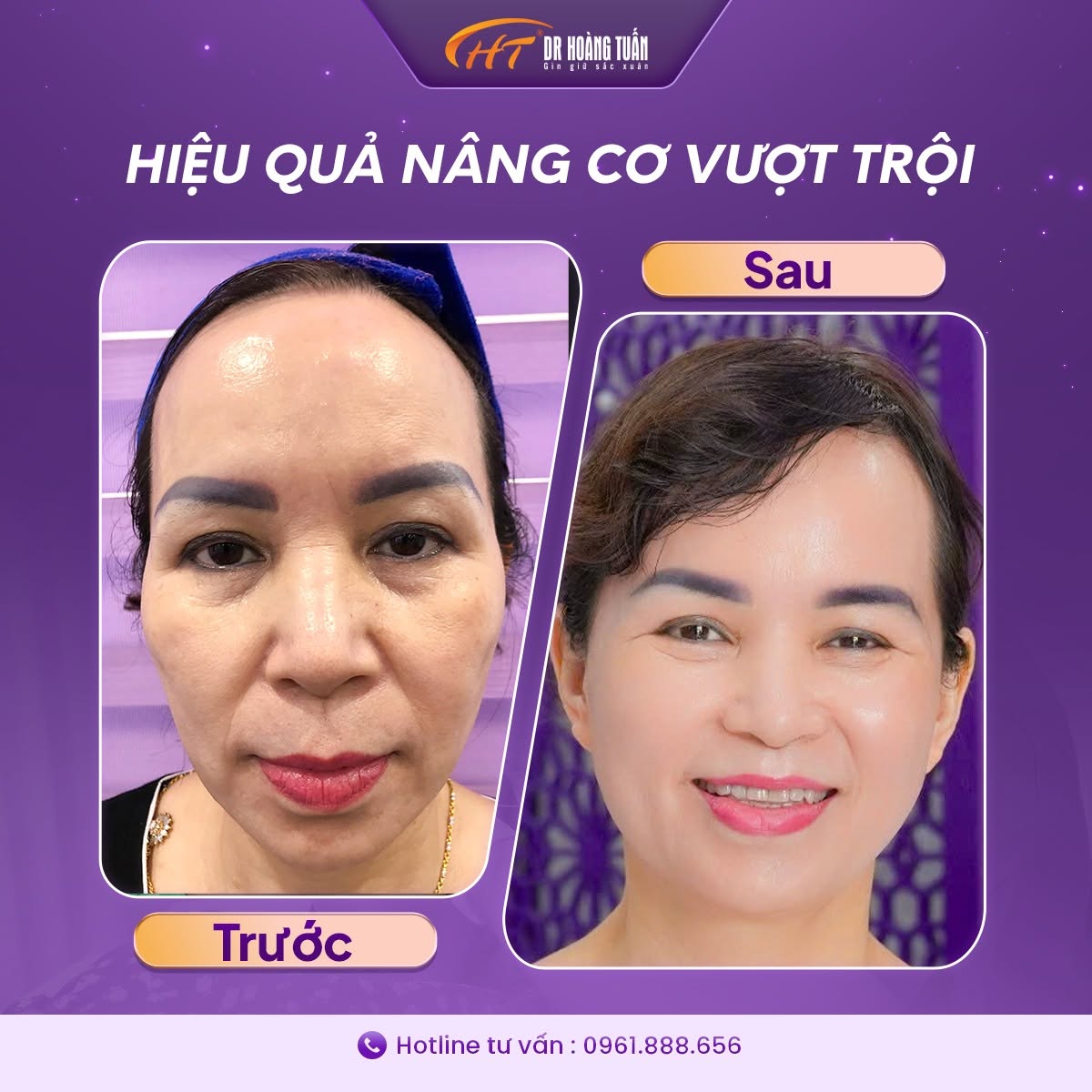 căng chỉ thái dương