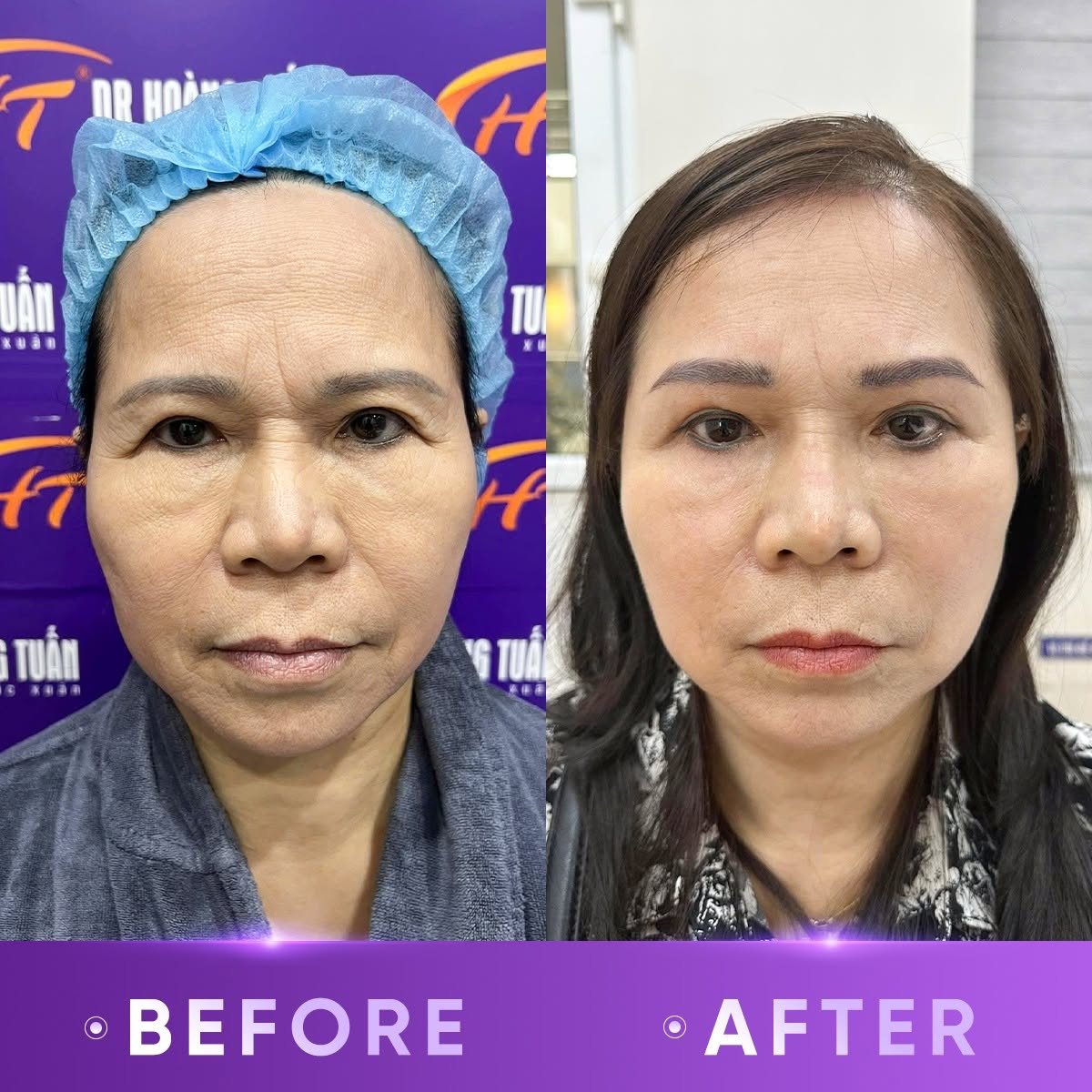 căng chỉ thái dương