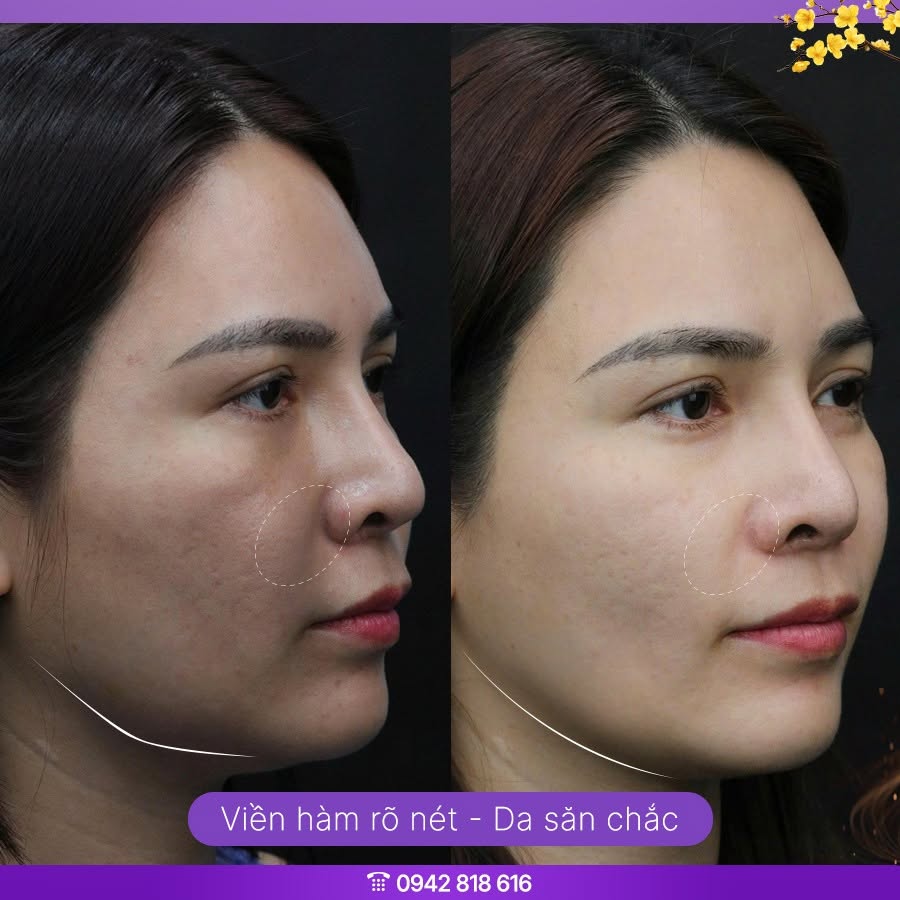 căng chỉ nọng cằm