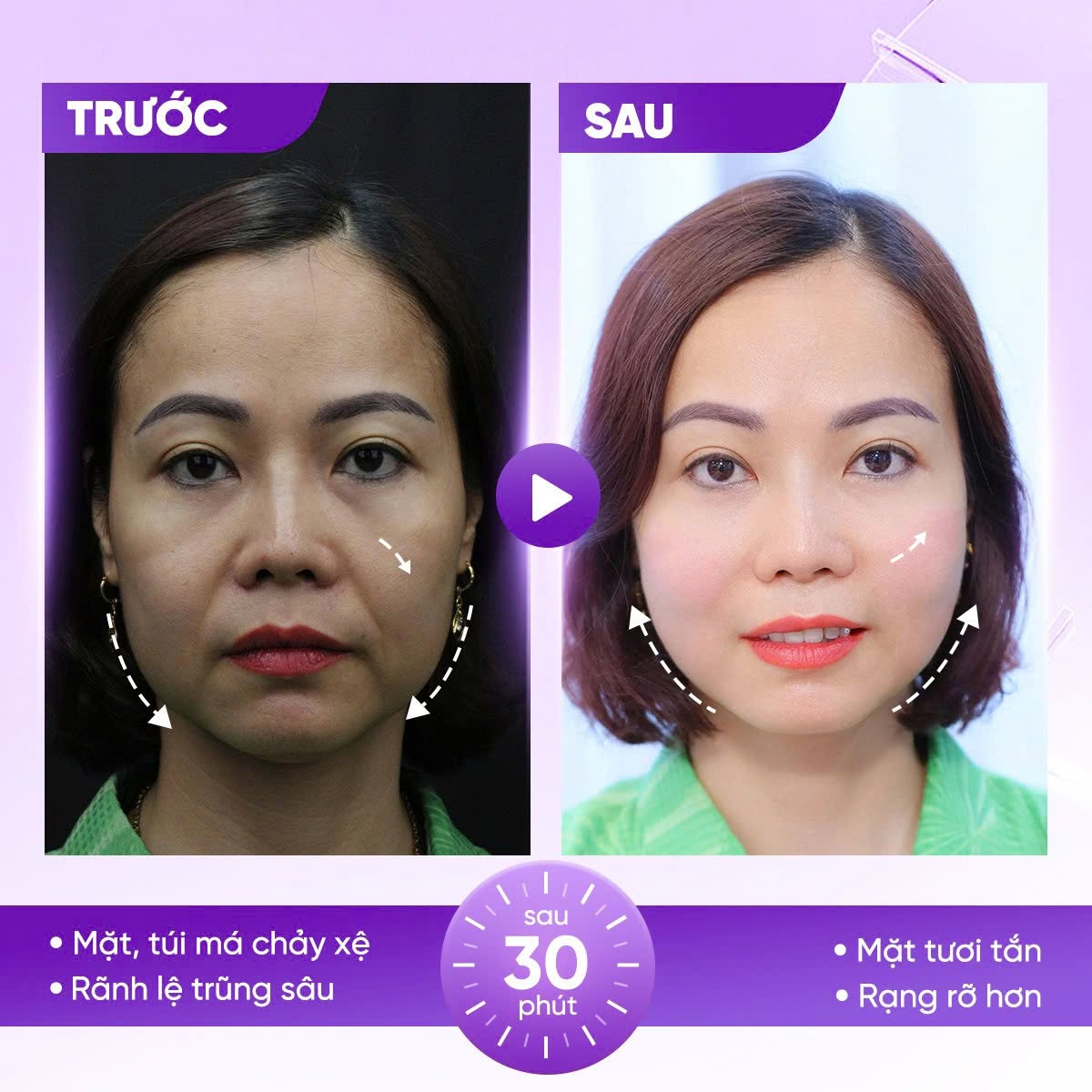 căng da mặt bằng chỉ có tốt không