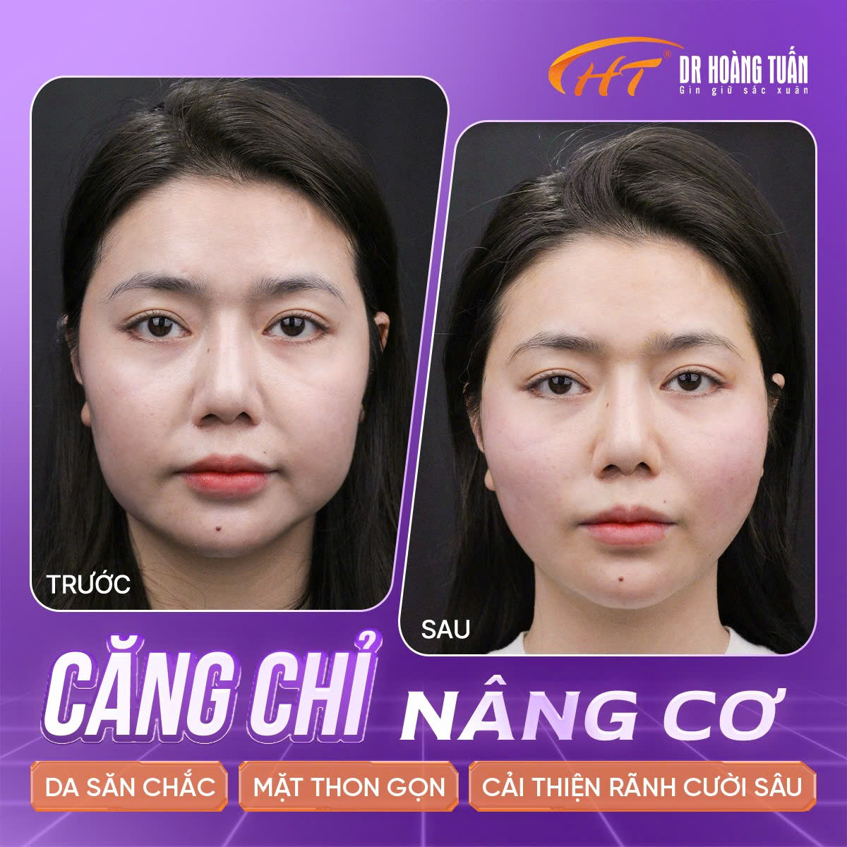 căng chỉ rãnh mũi má