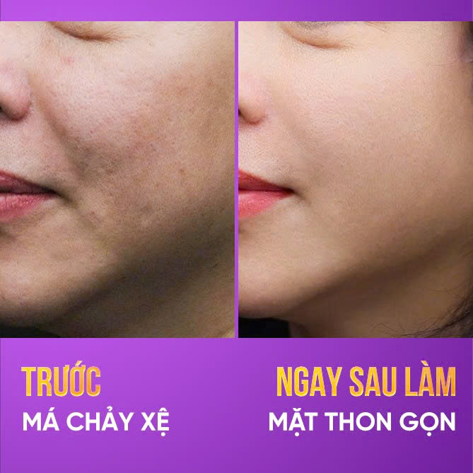 căng chỉ rãnh mũi má