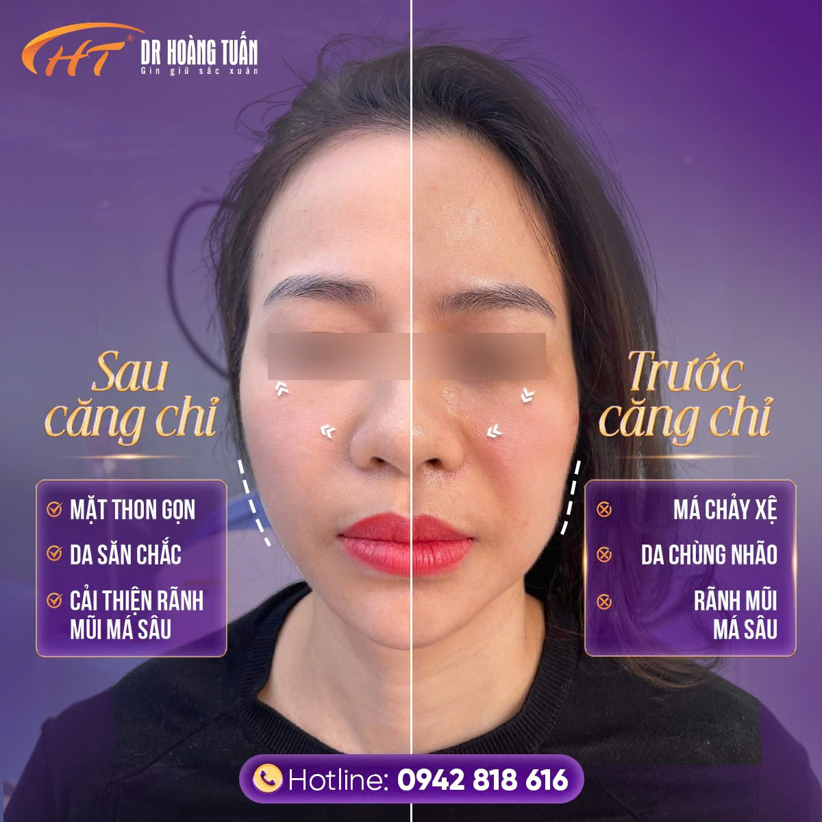 căng da mặt bằng chỉ có đau không
