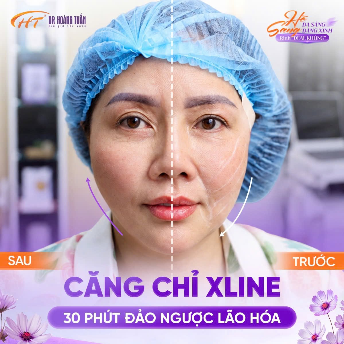 quy trình căng chỉ da mặt