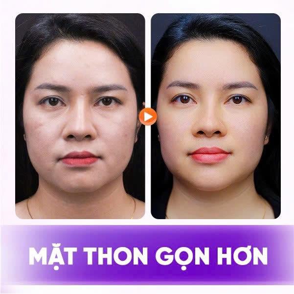 căng chỉ trẻ hoá da