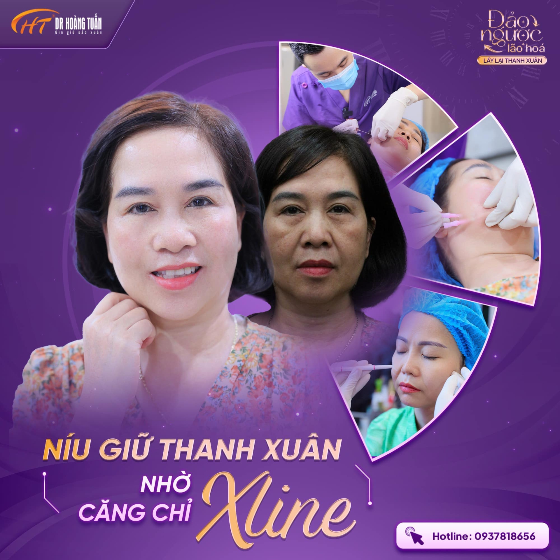 căng chỉ nâng cơ mặt