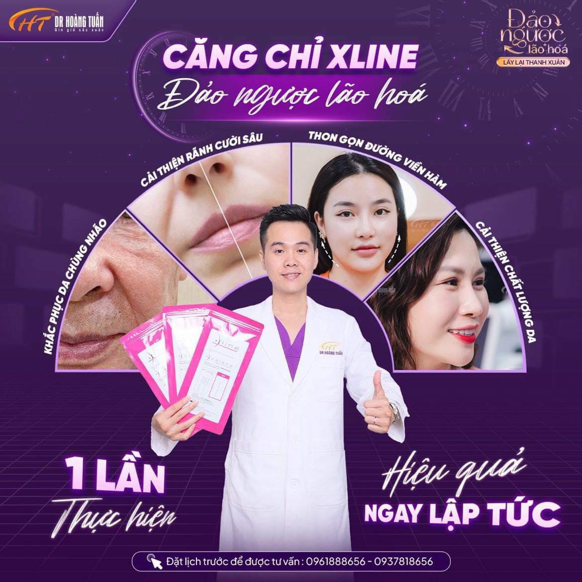 căng chỉ nâng cơ mặt