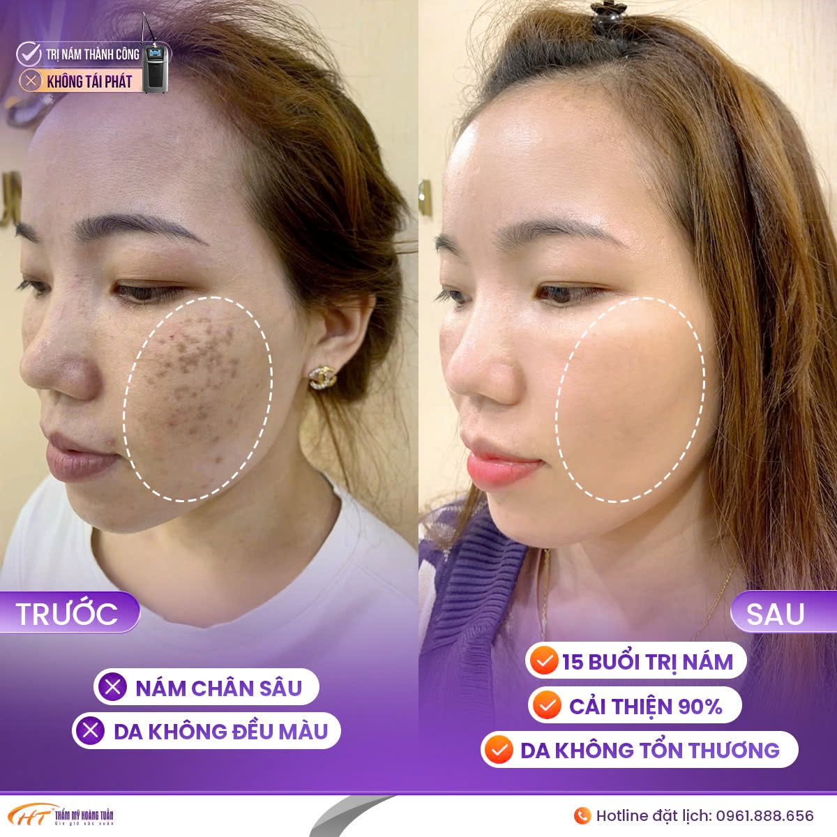 nám mảng và nám chân sâu