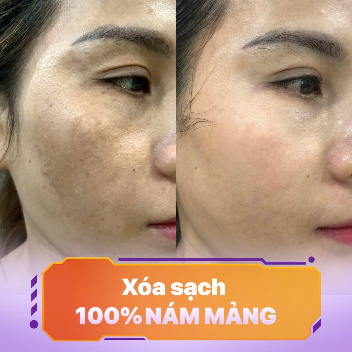 nám mảng và nám chân sâu