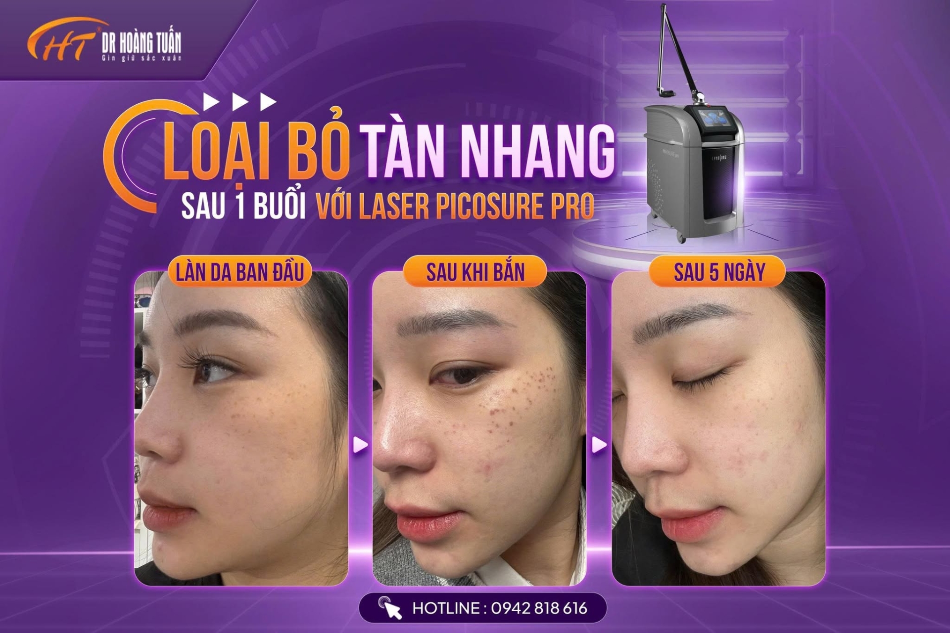 Tàn nhang có bị lan ra không