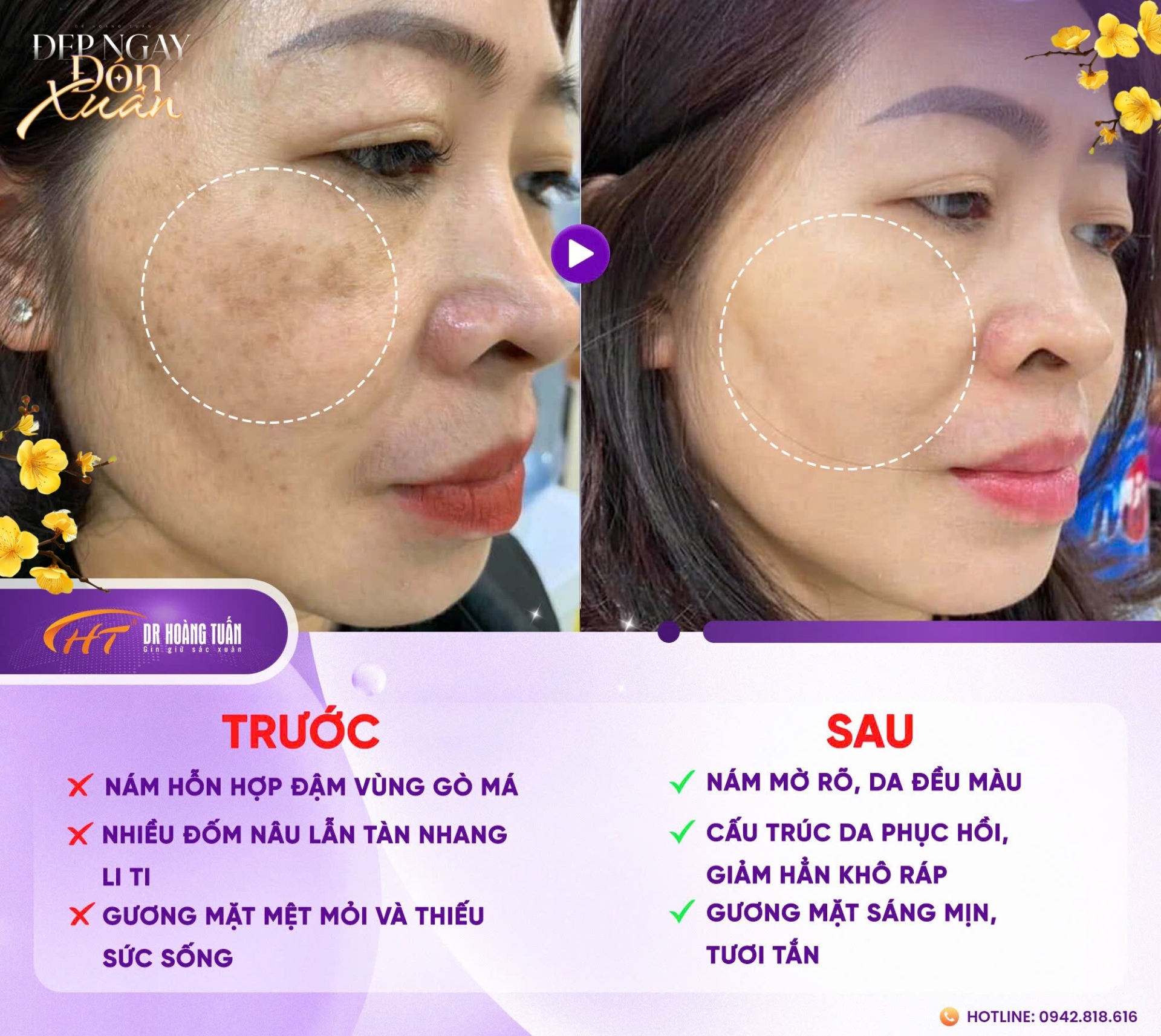 kinh nghiệm trị nám sau sinh
