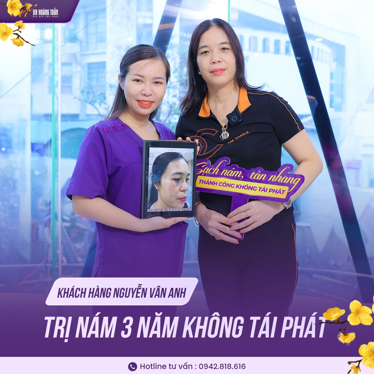 Kinh nghiệm trị nám bằng laser 