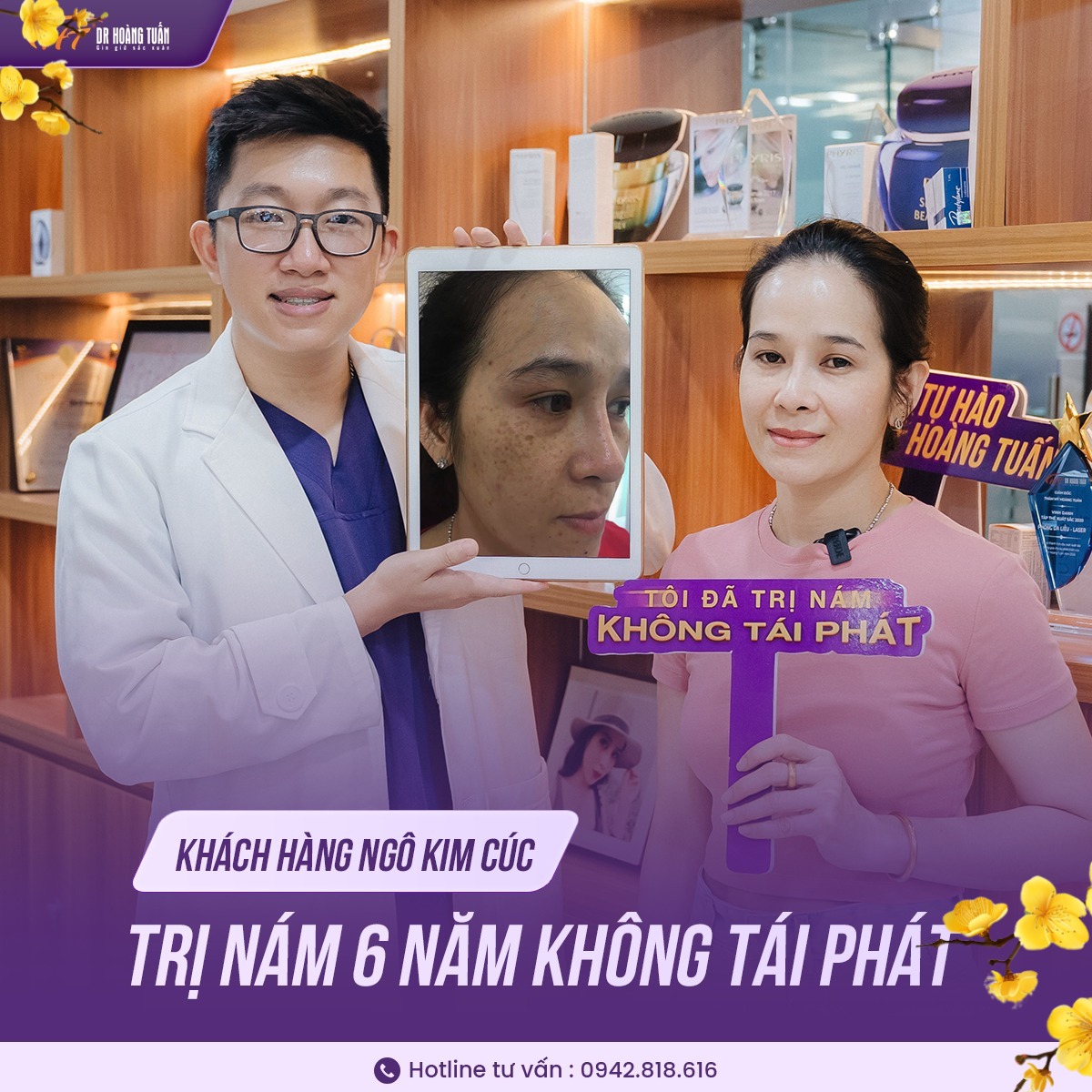 Kinh nghiệm trị nám bằng laser 