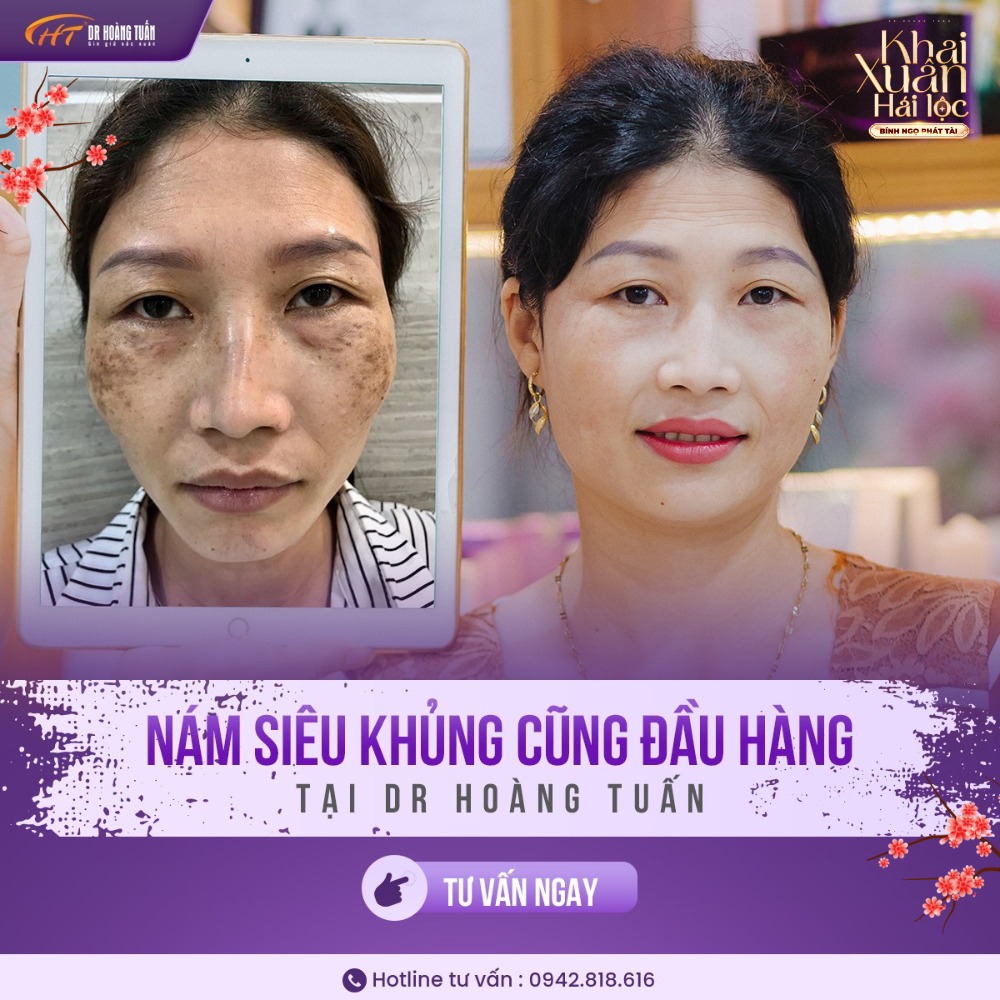 nám da tuổi 40