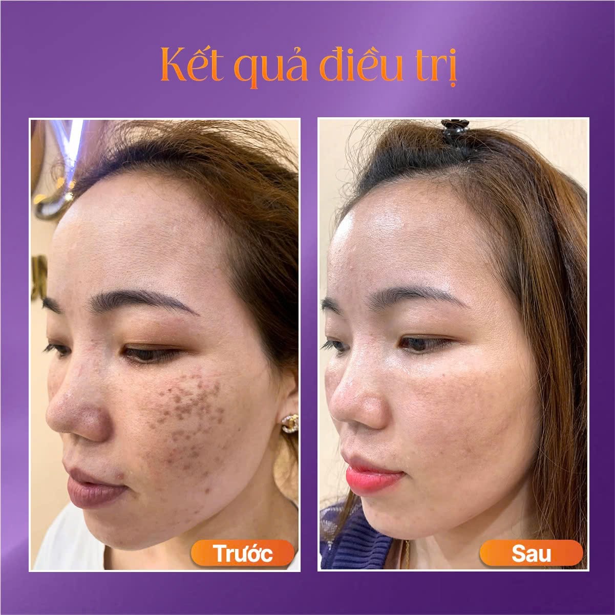 nám đốm