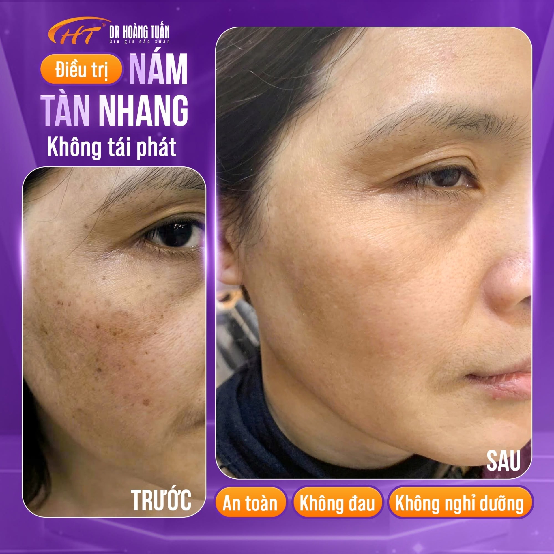tàn nhang có chữa được không