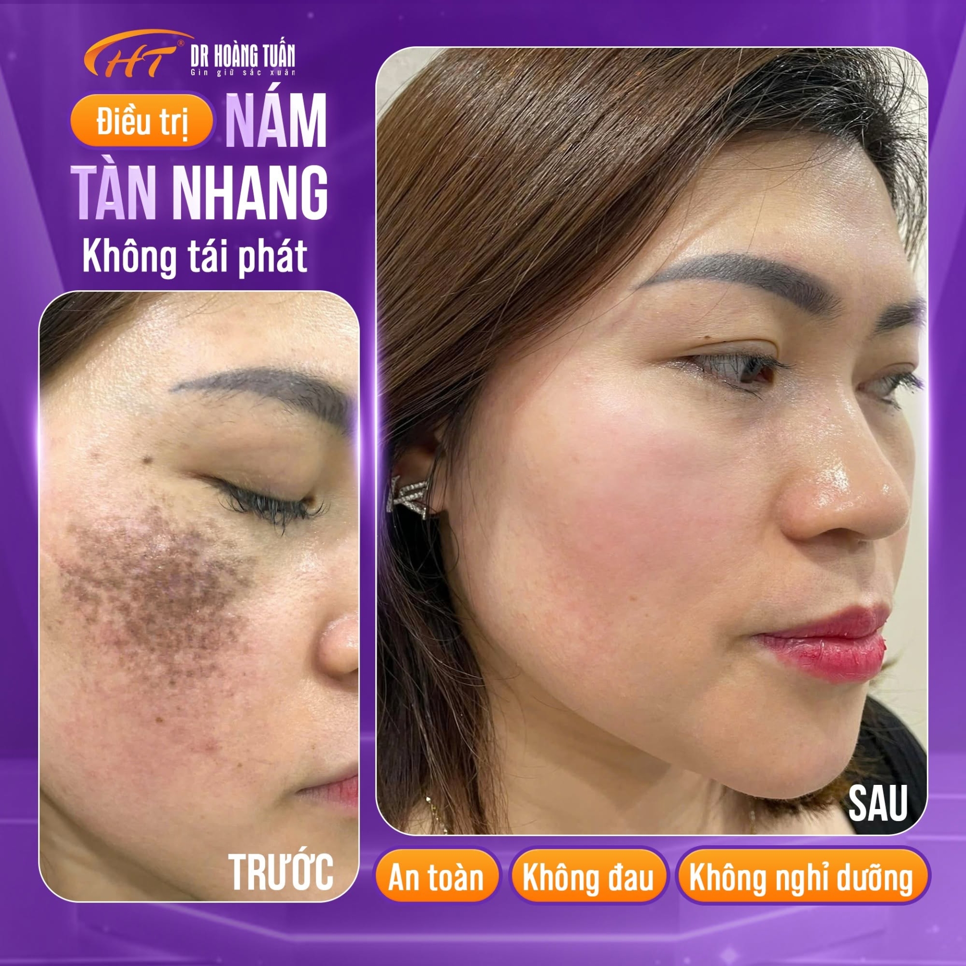 phân biệt đồi mồi và tàn nhang