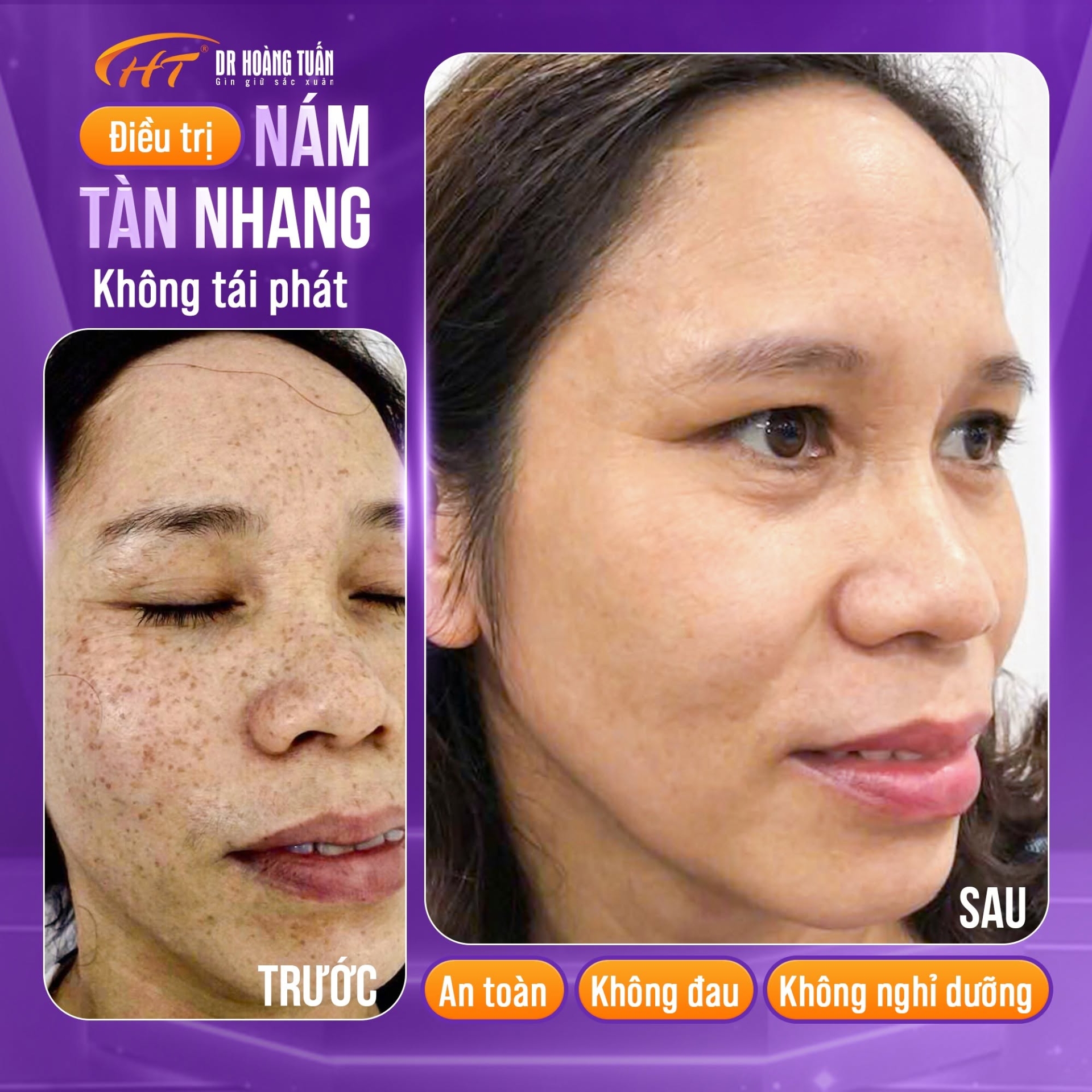 phân biệt đồi mồi và tàn nhang