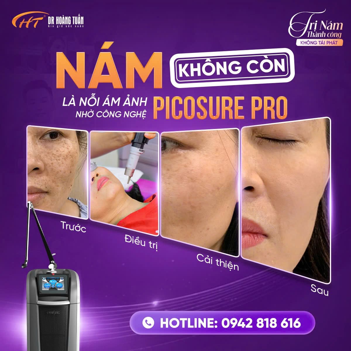 laser điều trị nám