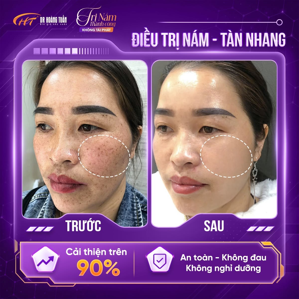 cách chống nám da mặt