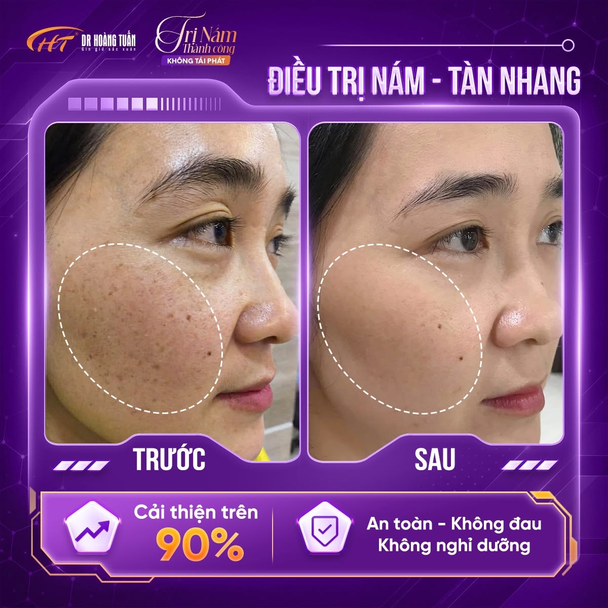 trị nám lâu năm