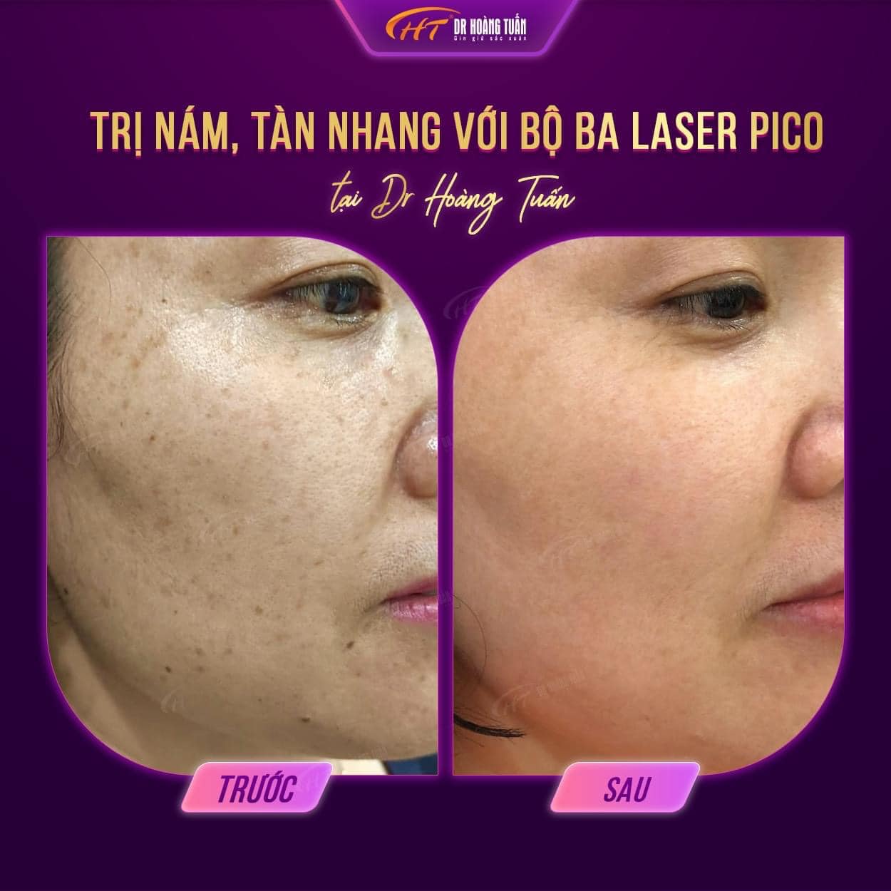 nám da nhẹ