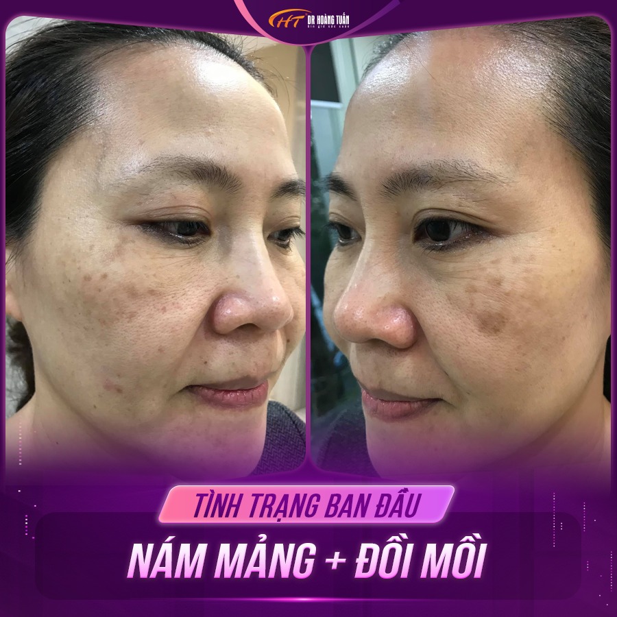 nám khác tàn nhang như nào