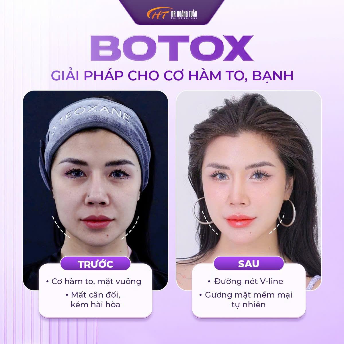 tiêm botox có hại gì không