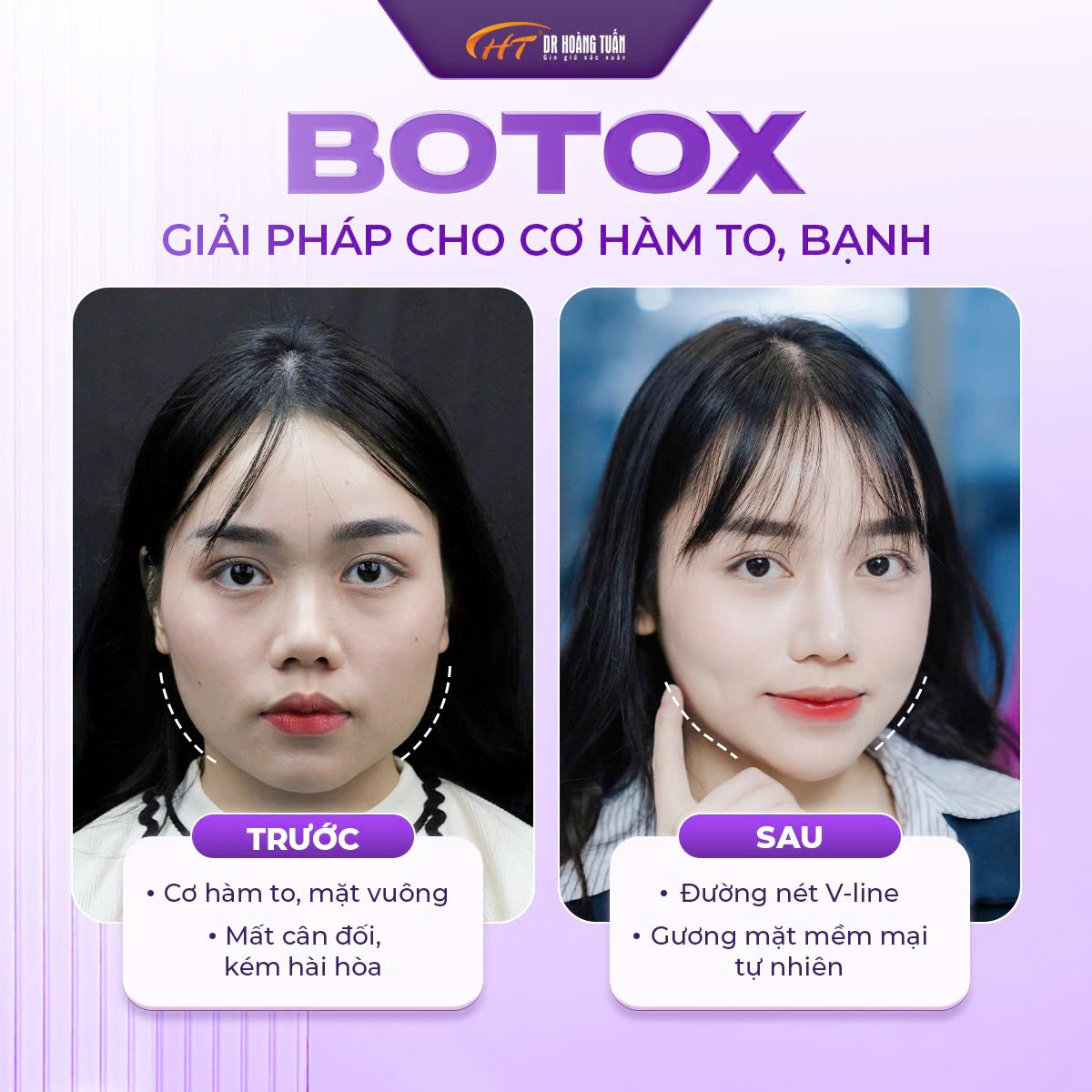 tiêm botox kiêng gì