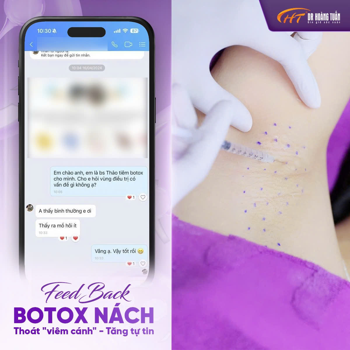 tiêm botox nách bao nhiêu tiền