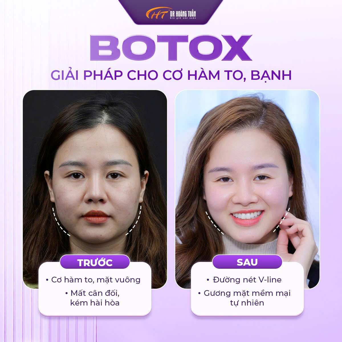 tiêm botox được bao lâu