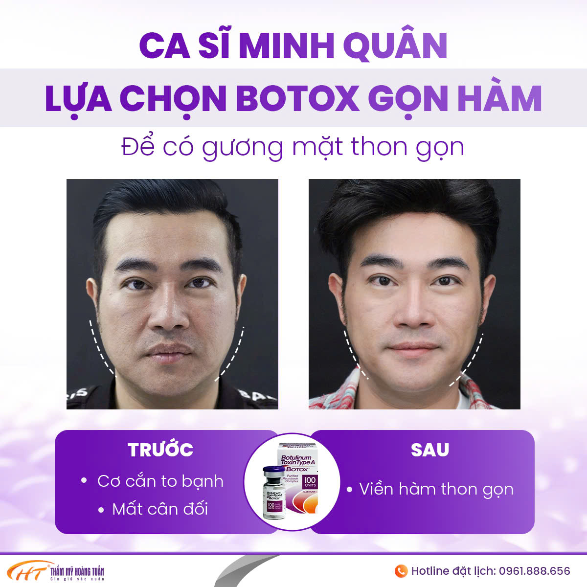 tiêm botox gọn hàm kiêng gì