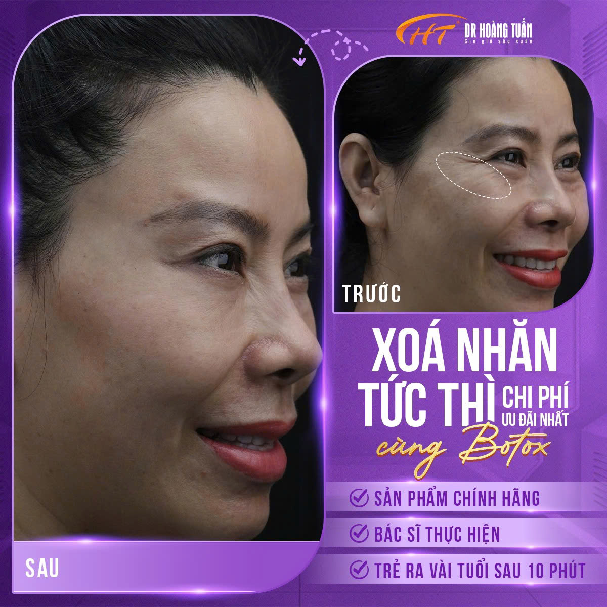 tiêm botox mắt