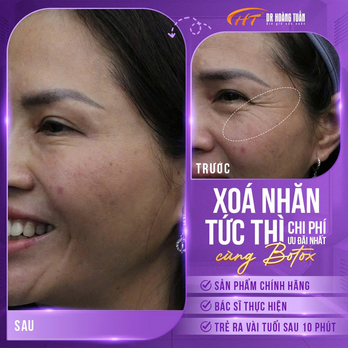 tiêm botox mắt