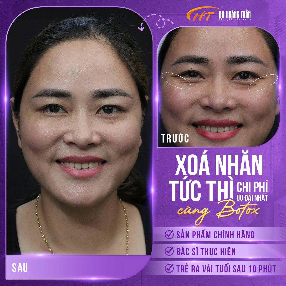 tiêm botox mắt