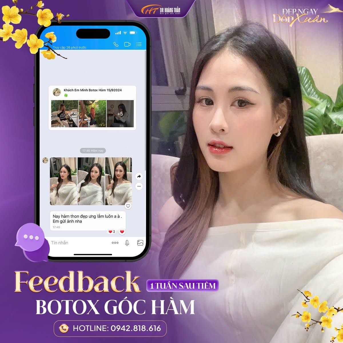 tiêm botox gọn hàm giữ được bao lâu