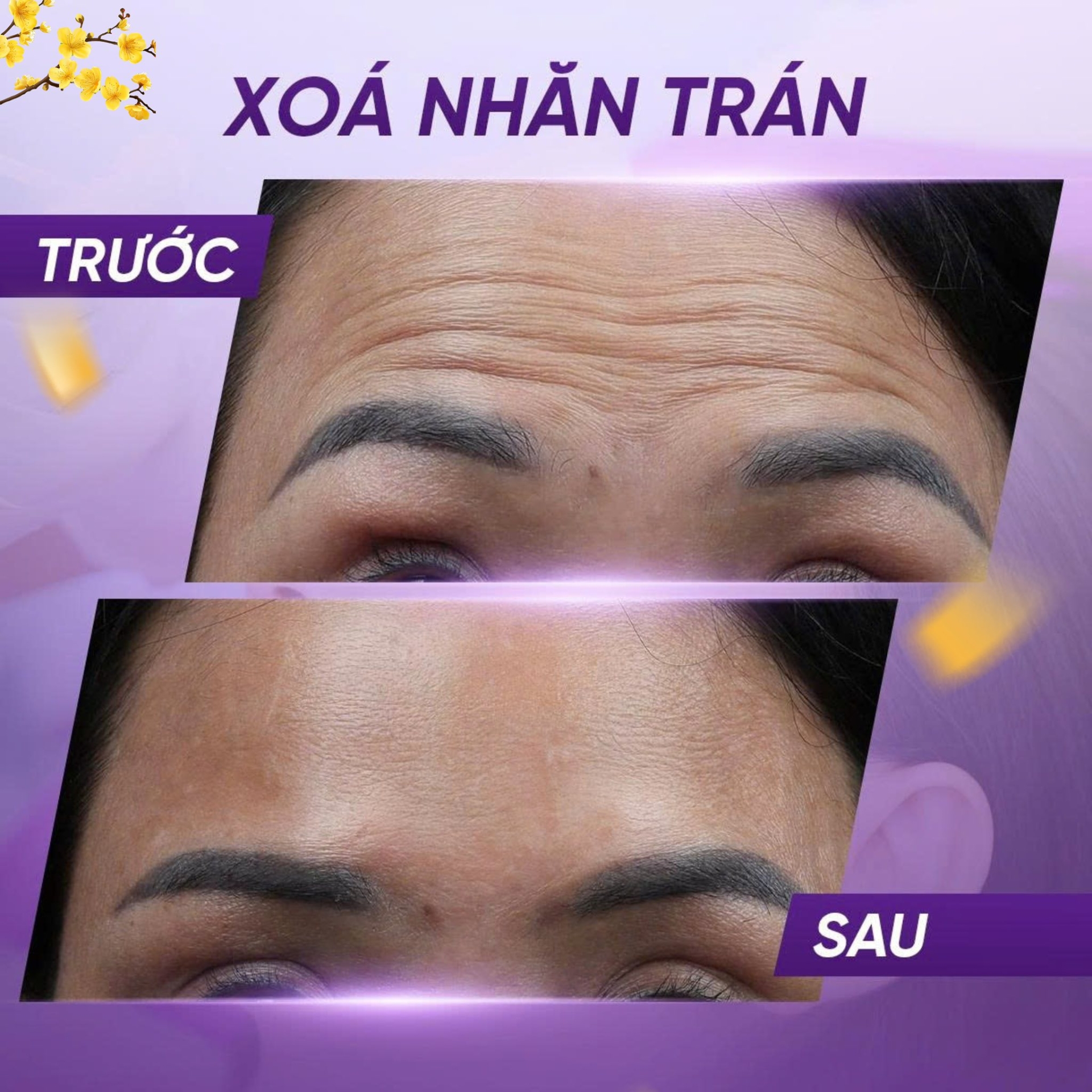 tiêm botox xóa nhăn bao lâu có hiệu quả