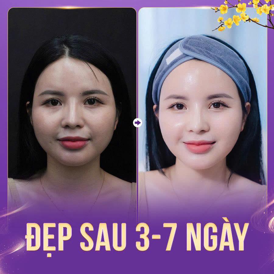 tiêm botox bao lâu thì tan