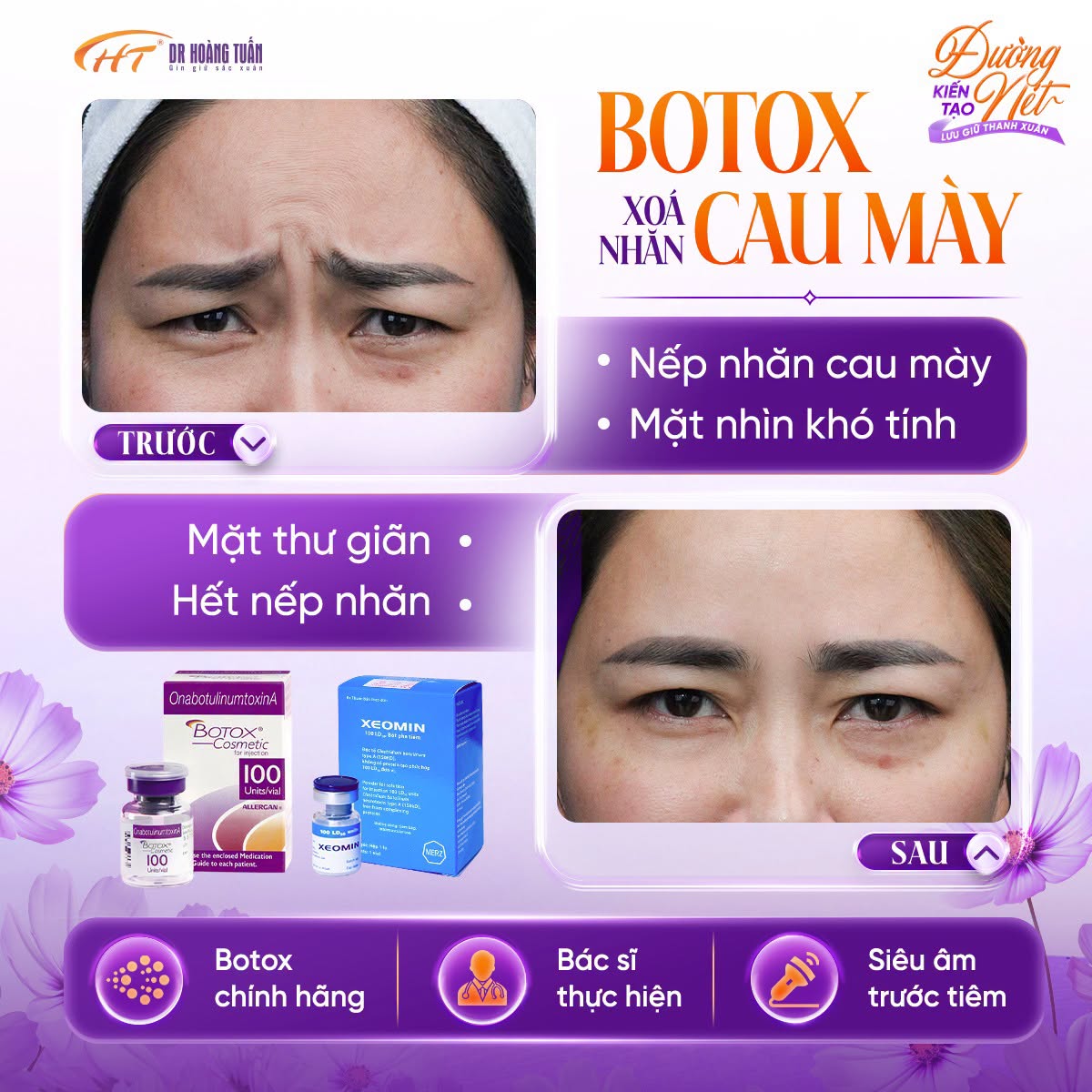 tiêm botox xóa nhăn bao lâu có hiệu quả