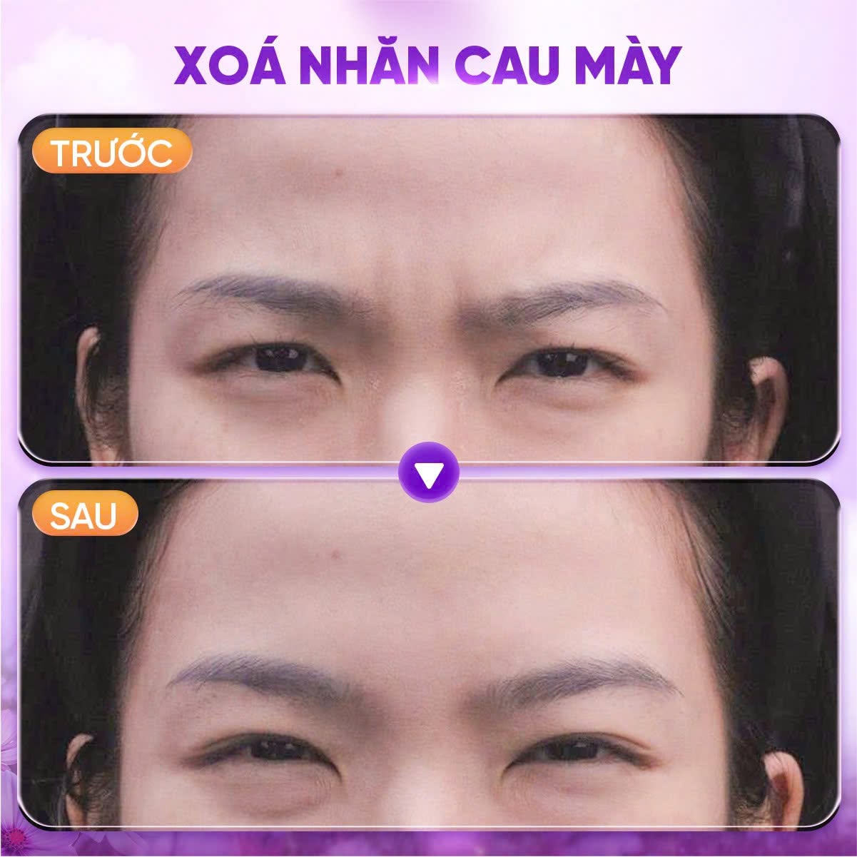 tiêm botox xóa nhăn cau mày