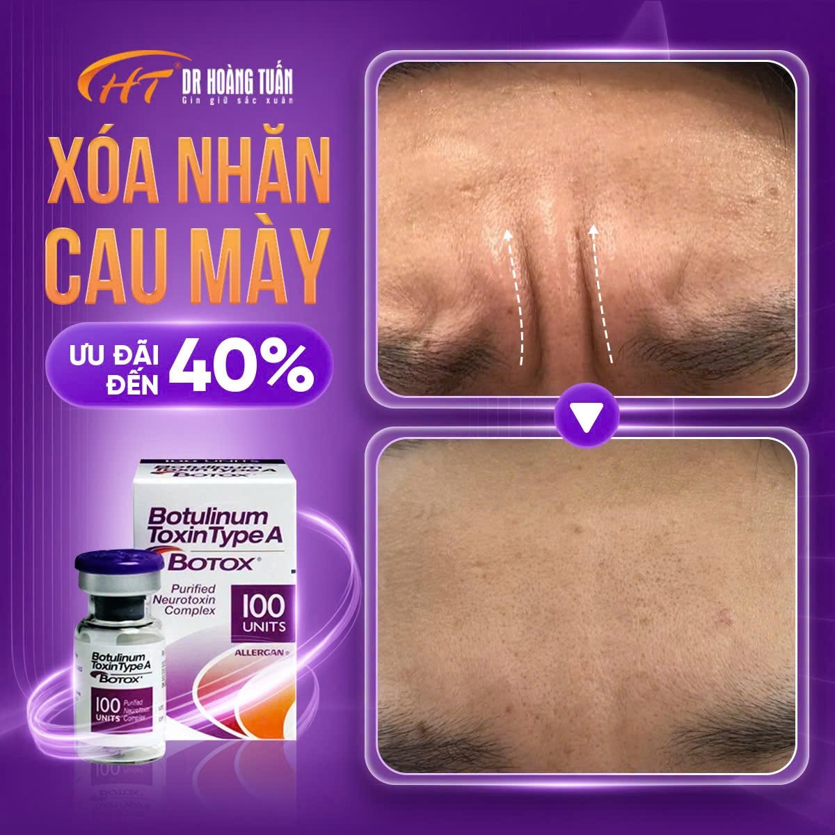tiêm botox xóa nhăn cau mày